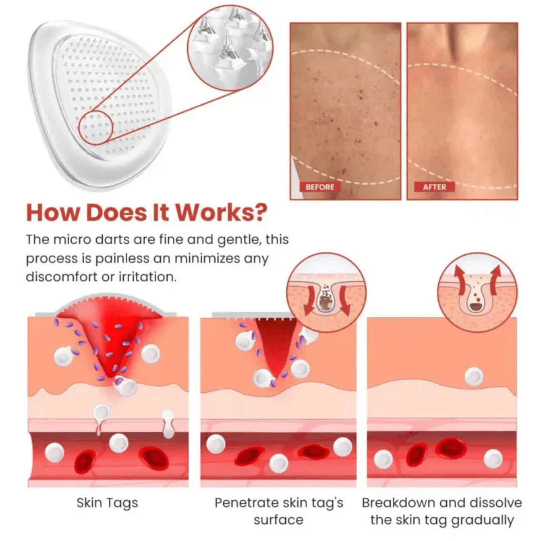 TALYO™ Derma Smooth Skin Patch – Instant Acne Or Skin Tag Treatment